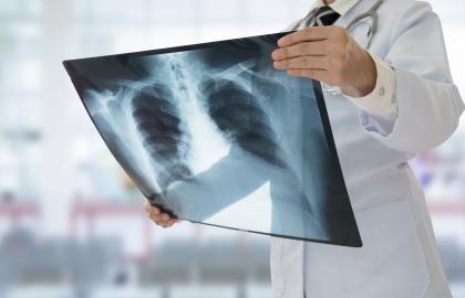 Bilde av lege som undersøker et røntgenbilde av lunger.